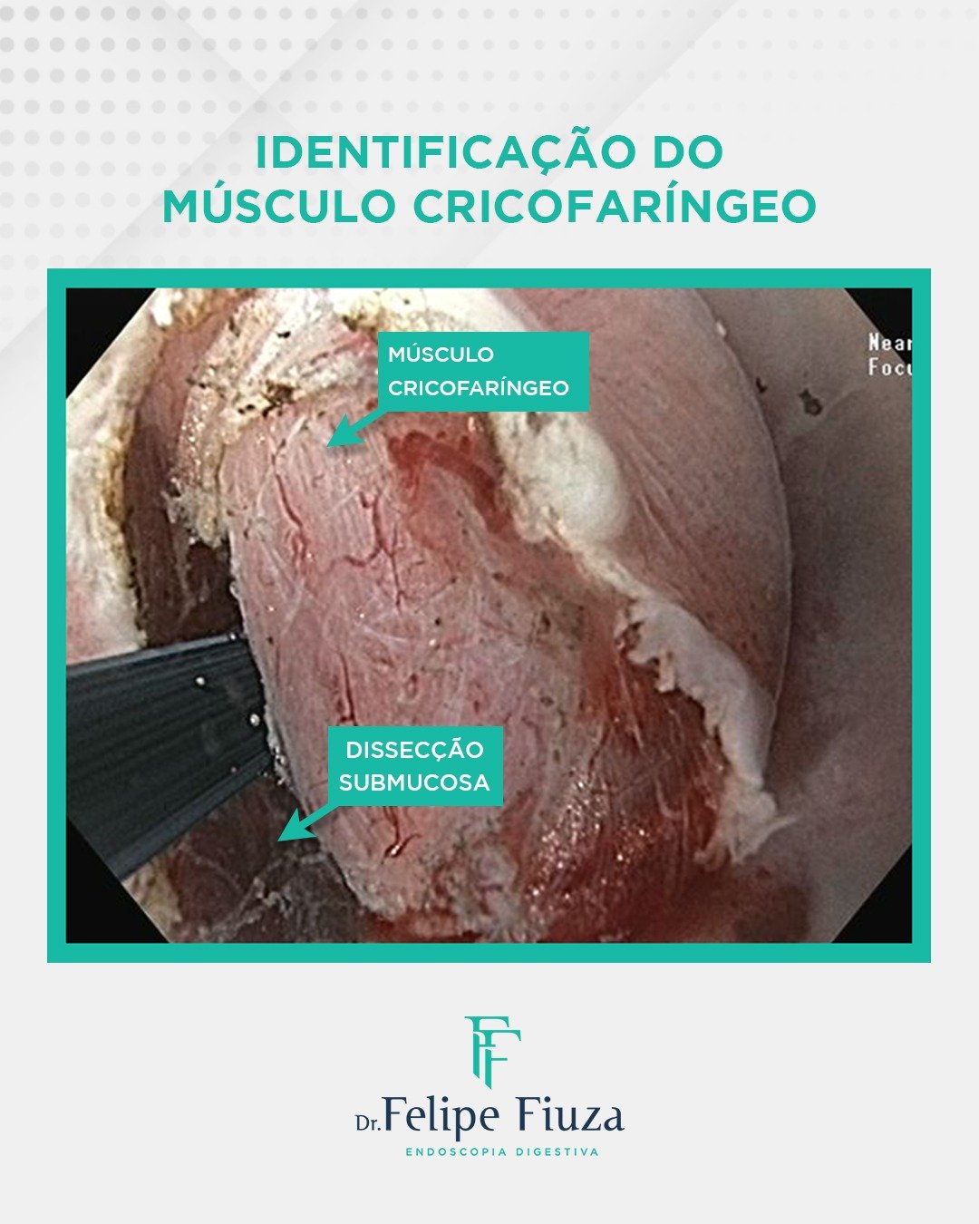 Z-POEM no divertículo de Zenker: tratamento minimamente invasivo