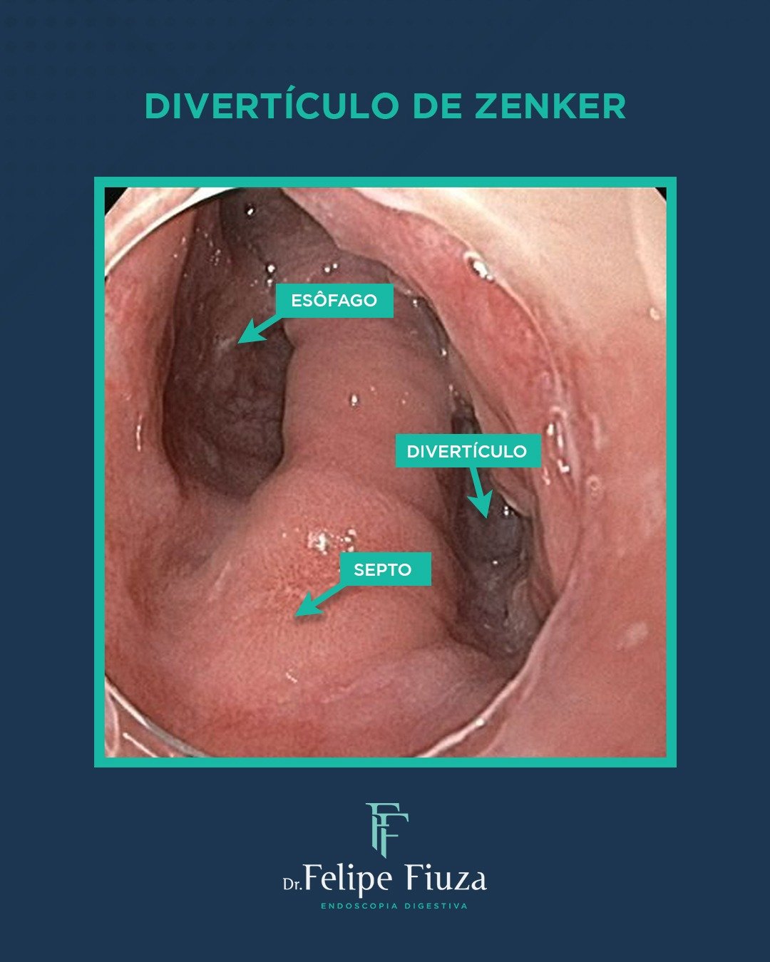 Z-POEM no divertículo de Zenker: tratamento minimamente invasivo